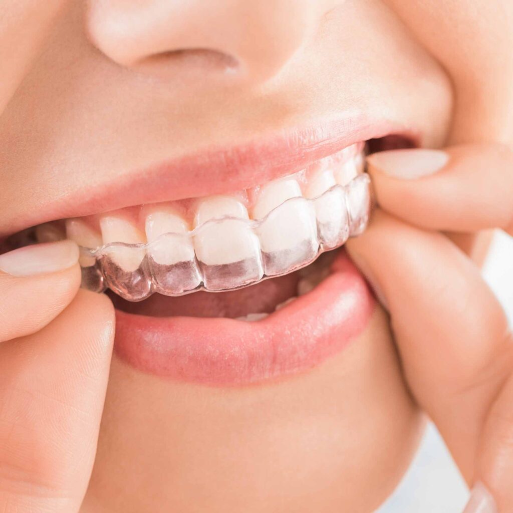 burckhard-ortho-hero-clear-aligners-smile